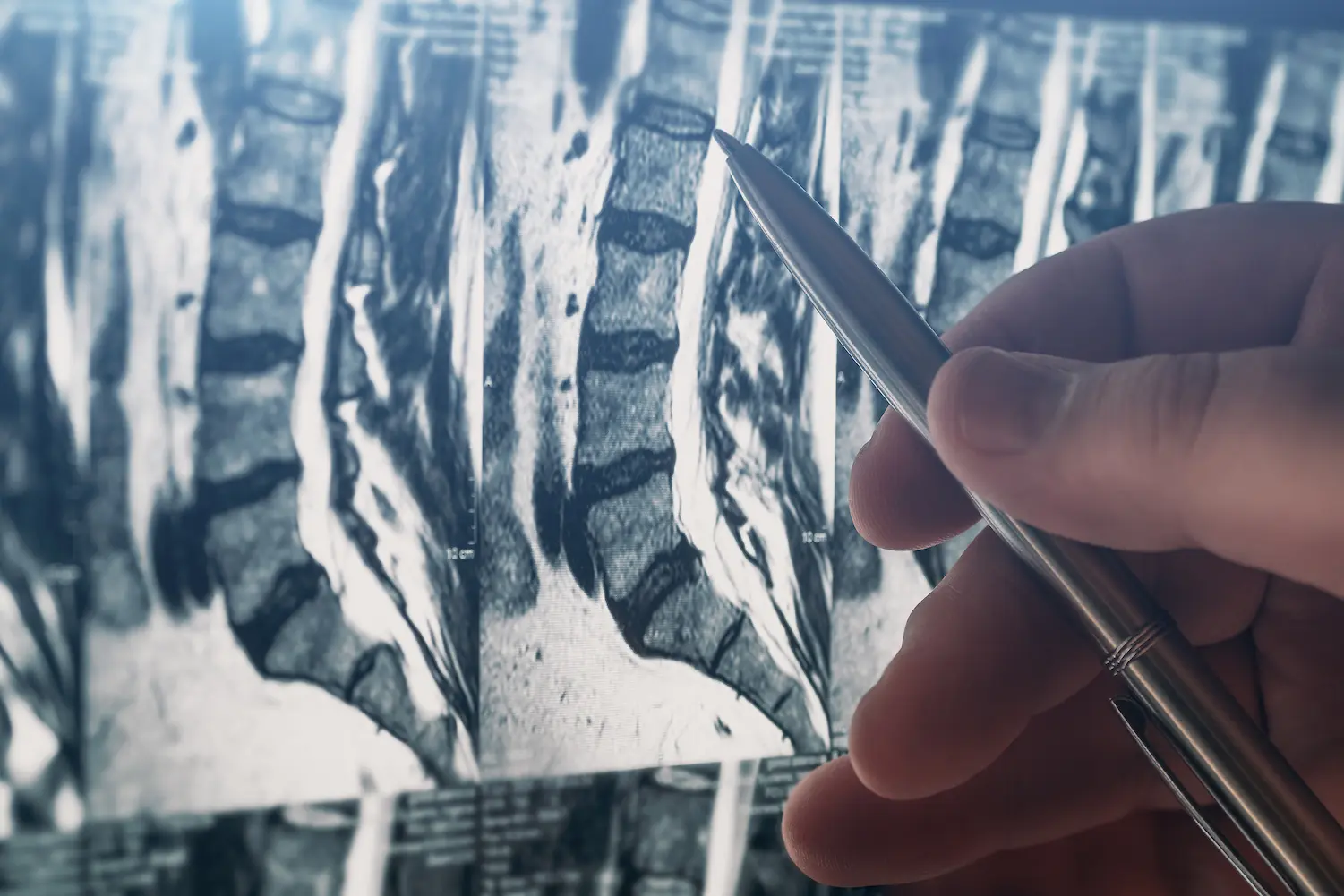 Doctor examines MRI of lumbar spine with pinched discs of spine and nerves, points at problem areas by pen, close-up